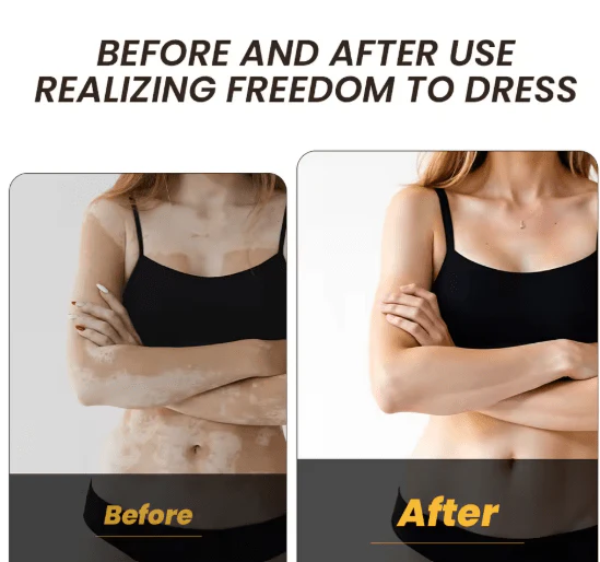 Vitamine Vitiligo Cream